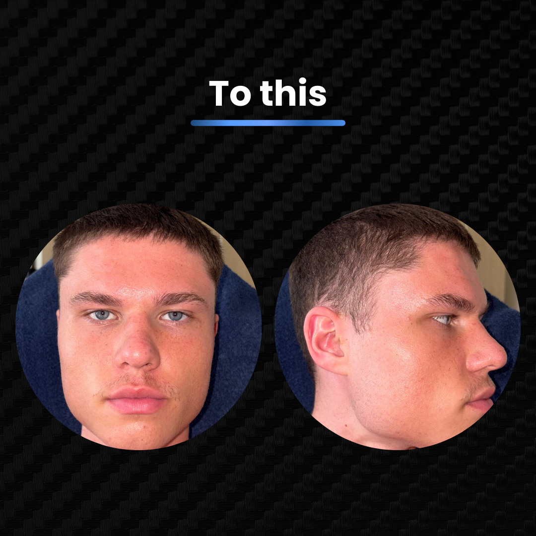 The Acne Code